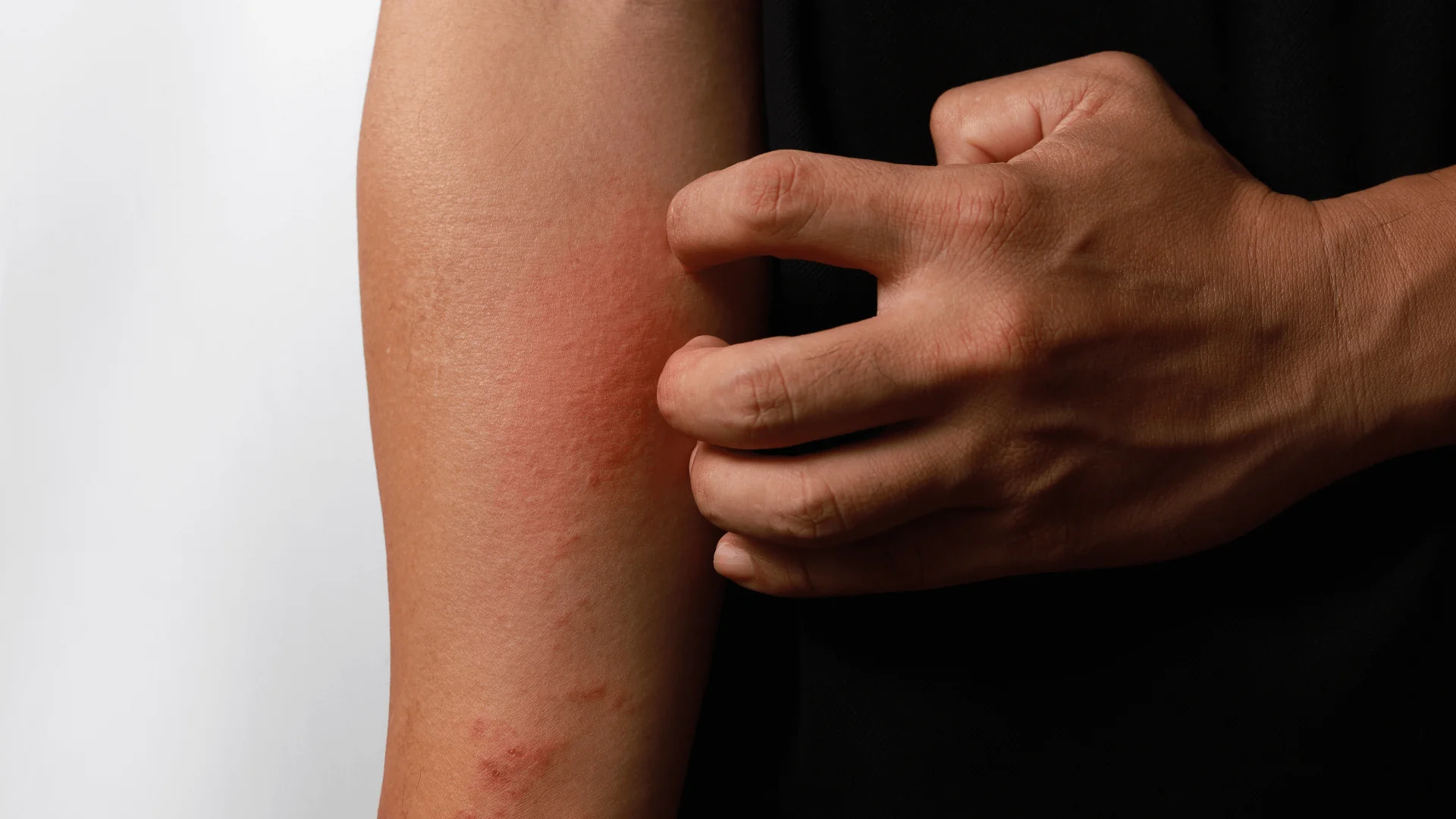 Eczema