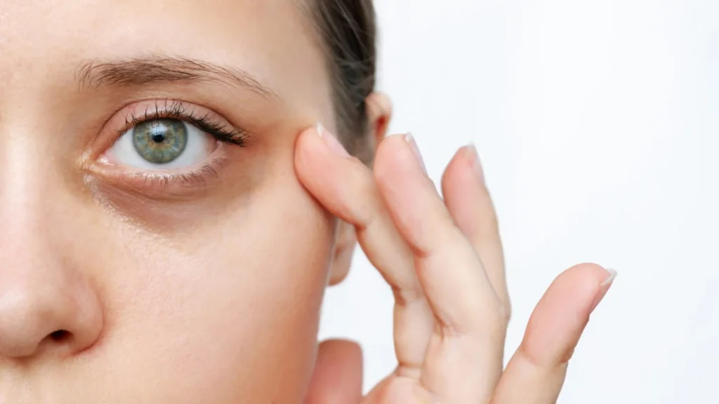 Under Eye Dark Circle Treatment