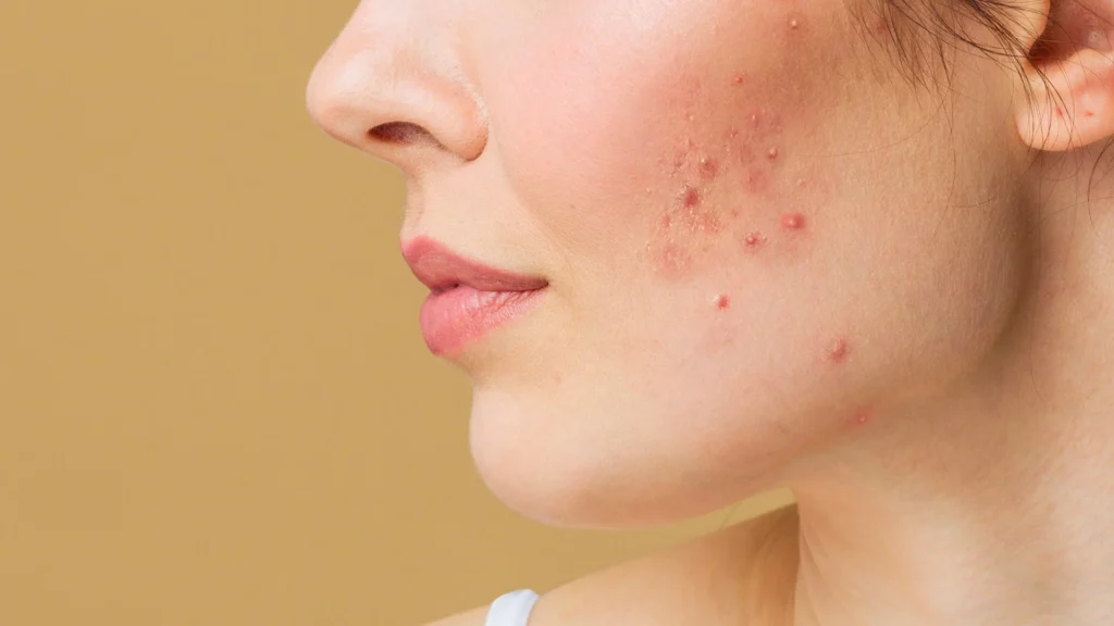 Acne Treatment