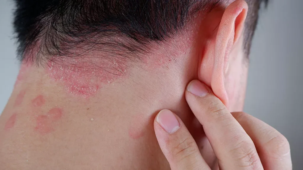 Psoriasis Treatment
