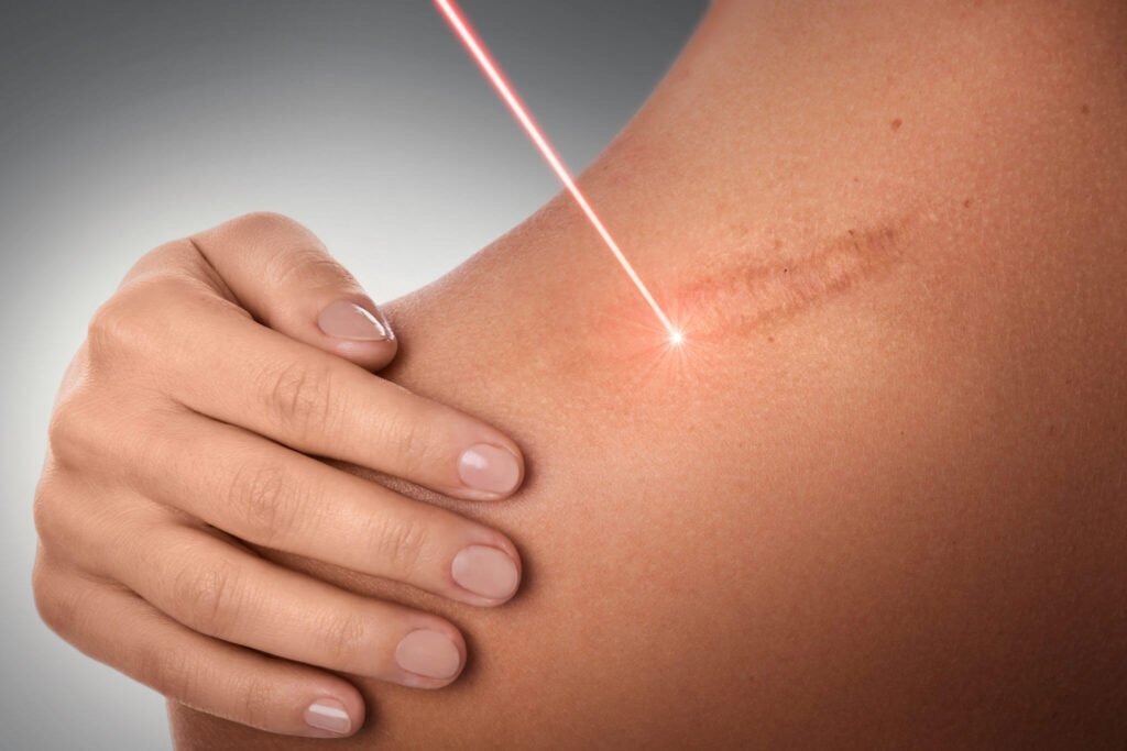 Scar Removal Treatment