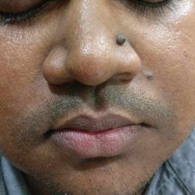 mole-removal-before