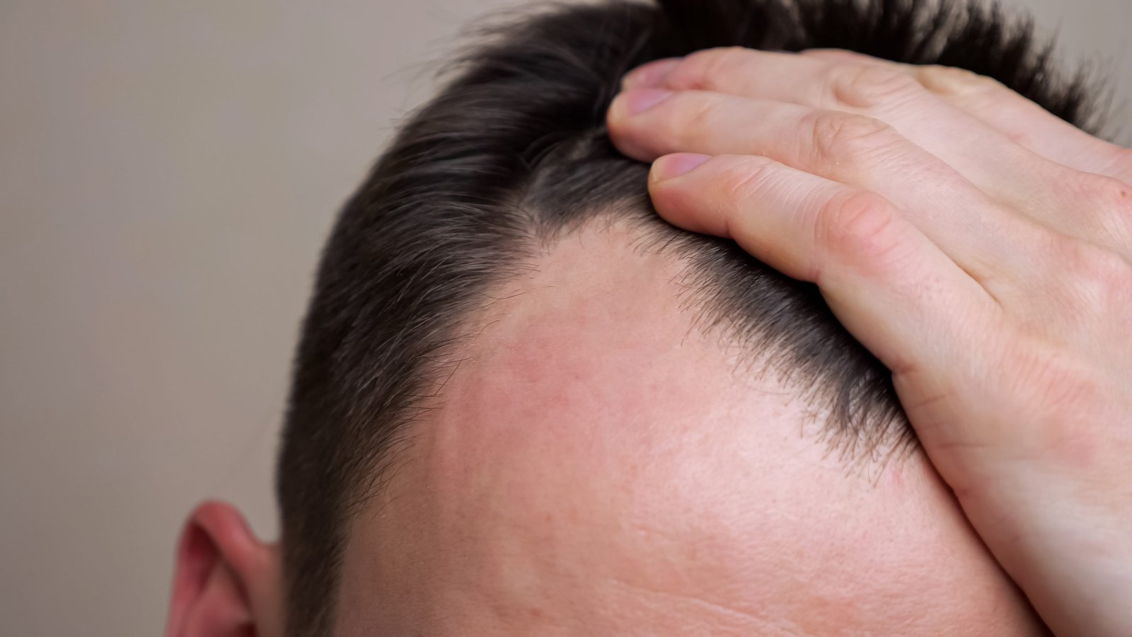 Hair Loss Treatment